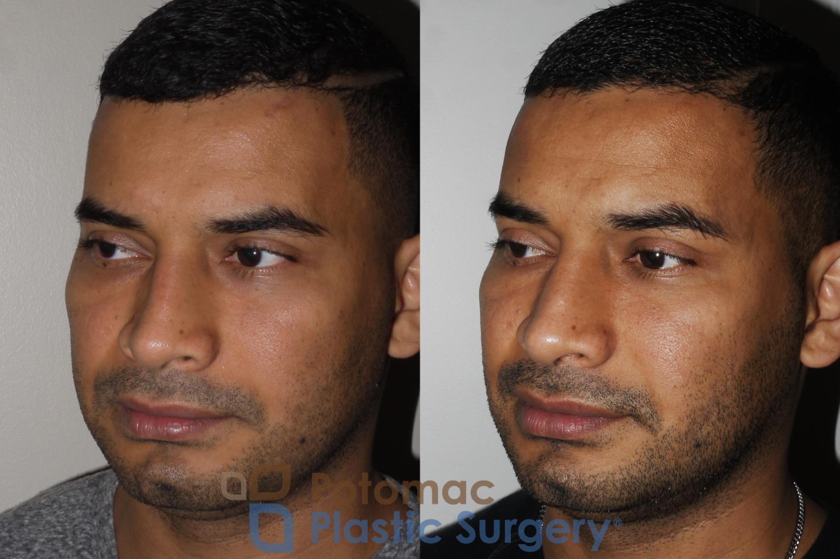 Before & After Rhinoplasty - Medical Case 190 Left Oblique View in Washington DC & Arlington , DC