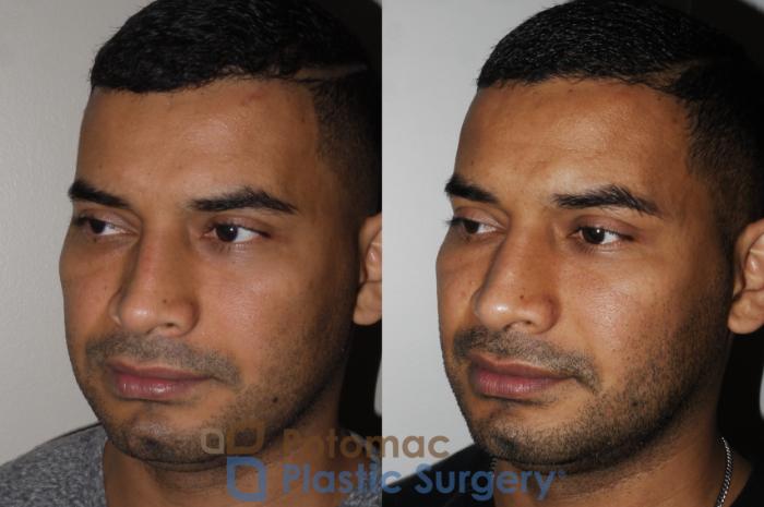 Before & After Rhinoplasty - Medical Case 190 Left Oblique View in Washington, DC