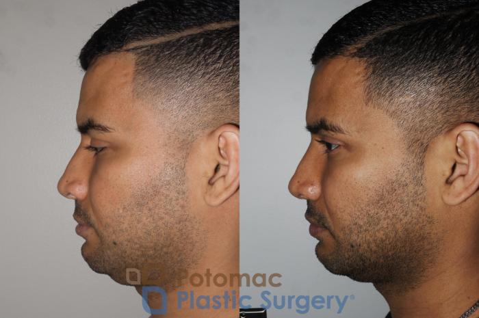 Before & After Rhinoplasty - Cosmetic Case 190 Left Side View in Washington DC & Arlington , DC
