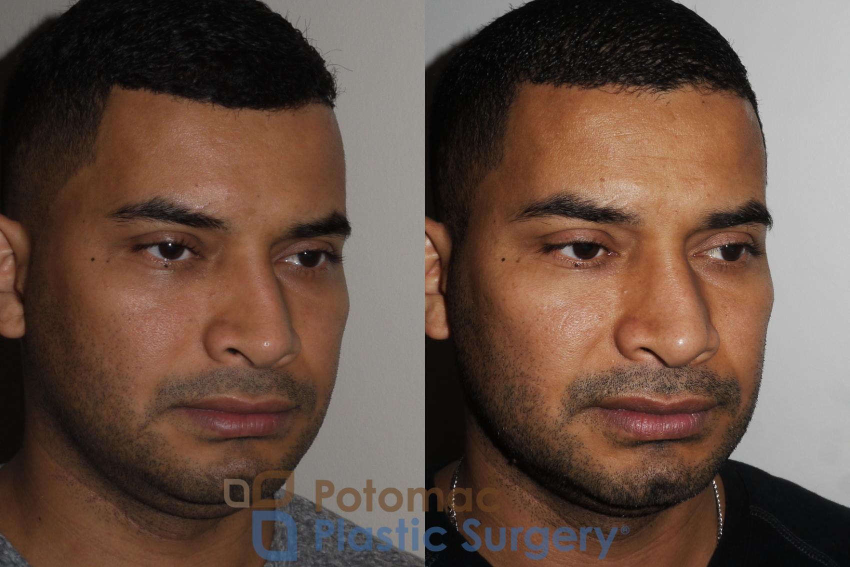 Before & After Rhinoplasty - Medical Case 190 Right Oblique View in Washington DC & Arlington , DC