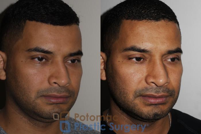 Before & After Rhinoplasty - Cosmetic Case 190 Right Oblique View in Washington DC & Arlington , DC