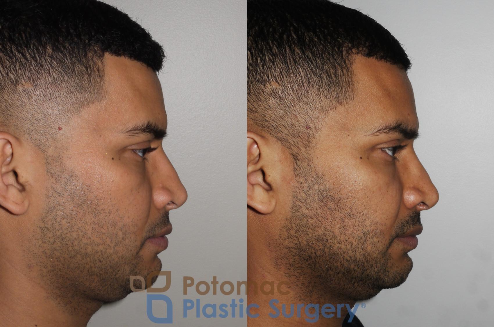 Before & After Rhinoplasty - Medical Case 190 Right Side View in Washington DC & Arlington , DC