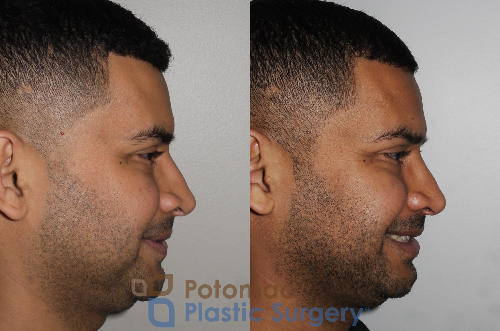 Before & After Rhinoplasty - Medical Case 190 Right Side View #2 View in Washington DC & Arlington , DC
