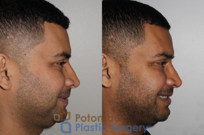 Before & After Rhinoplasty - Medical Case 190 Right Side View #2 View in Washington, DC