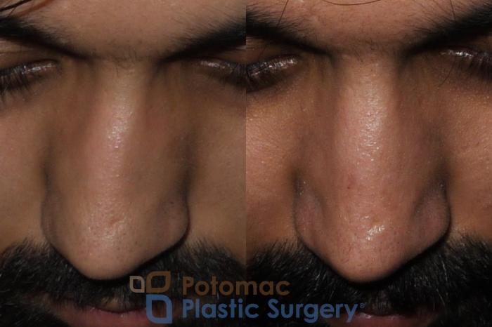 Before & After Rhinoplasty - Medical Case 192 Above View in Washington DC & Arlington , DC