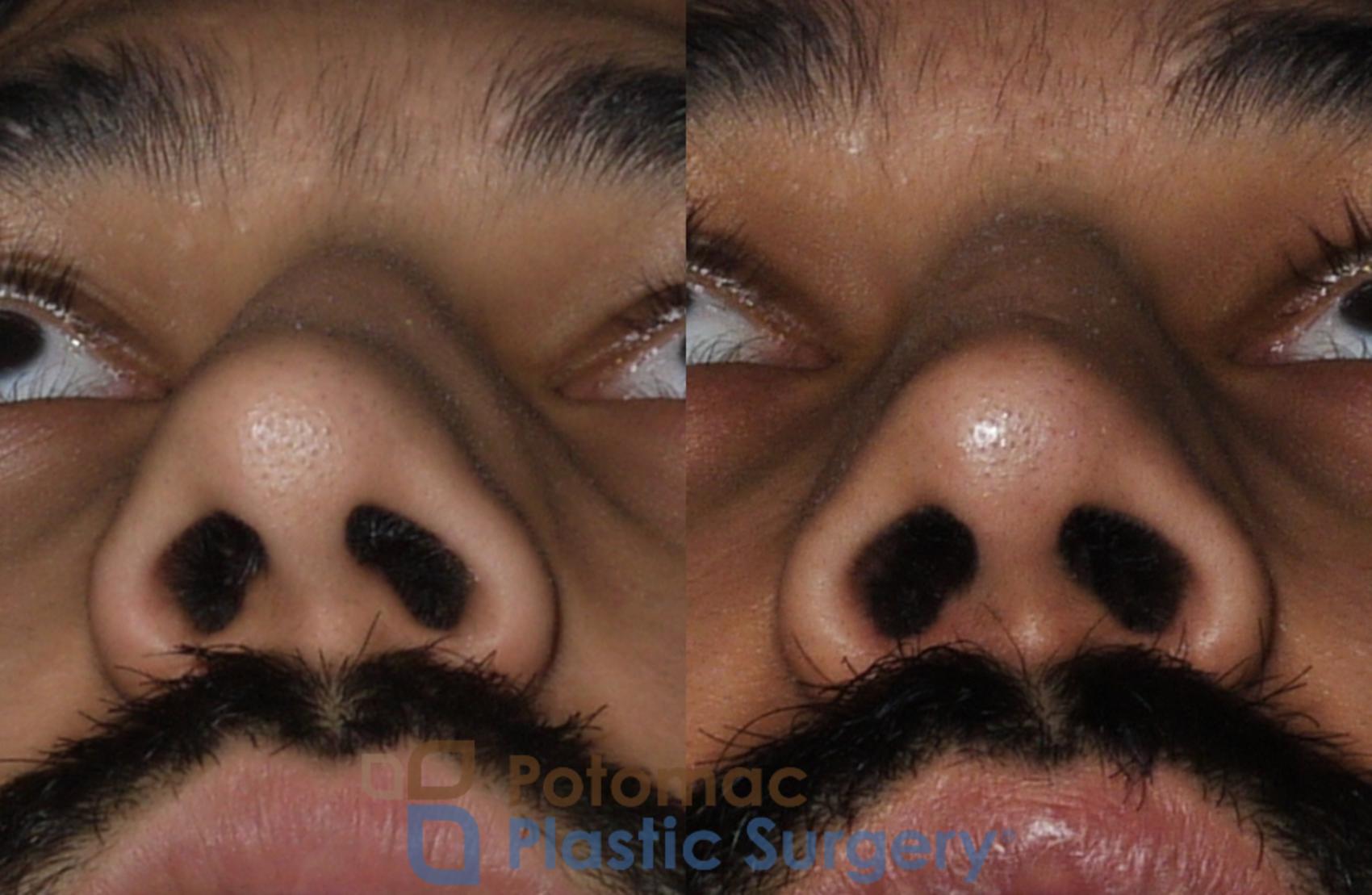 Before & After Rhinoplasty - Cosmetic Case 192 Below View in Washington DC & Arlington , DC