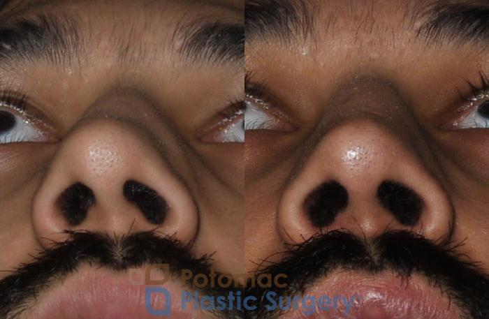 Before & After Rhinoplasty - Cosmetic Case 192 Below View in Washington DC & Arlington , DC