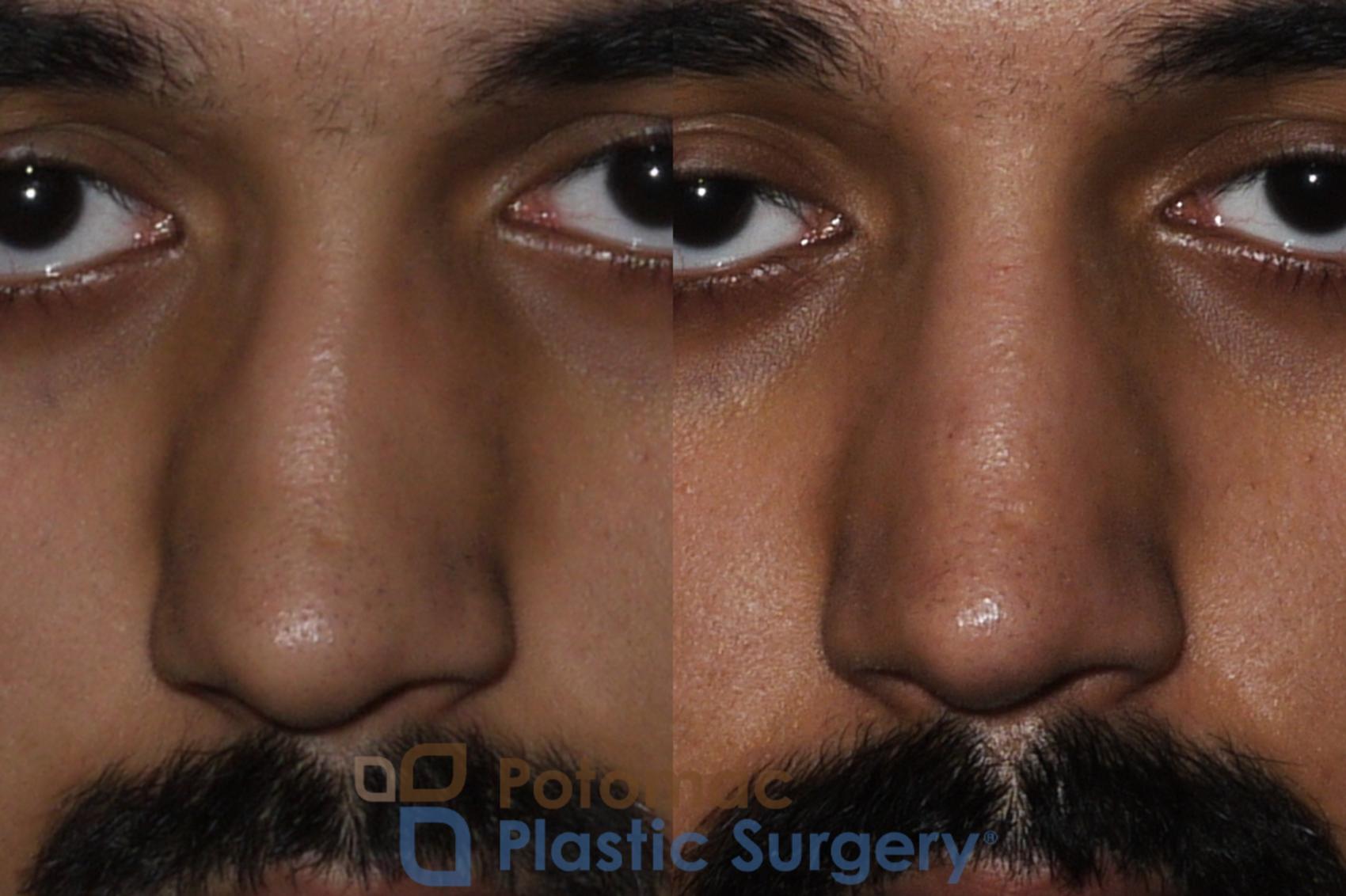 Before & After Rhinoplasty - Cosmetic Case 192 Front View in Washington, DC