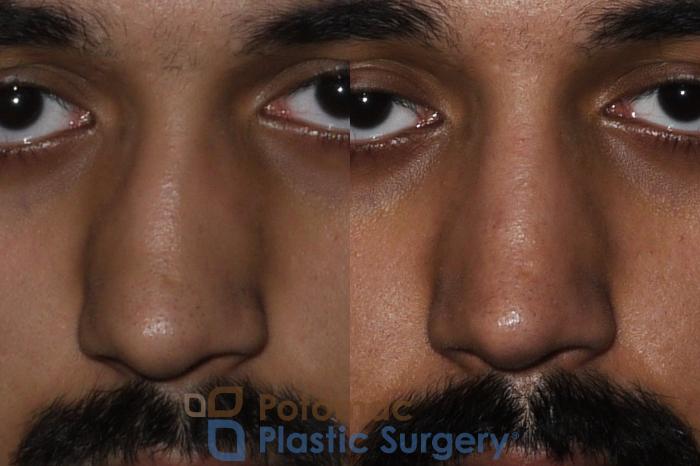 Before & After Rhinoplasty - Cosmetic Case 192 Front View in Washington DC & Arlington , DC