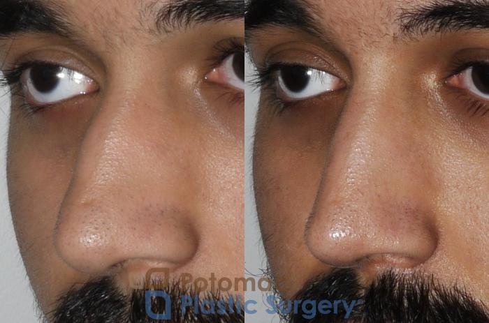 Before & After Rhinoplasty - Medical Case 192 Left Oblique View in Washington DC & Arlington , DC