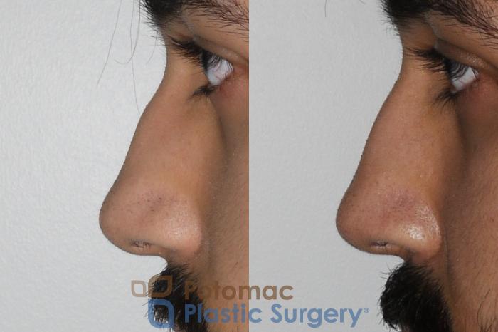 Before & After Rhinoplasty - Cosmetic Case 192 Left Side View in Washington DC & Arlington , DC