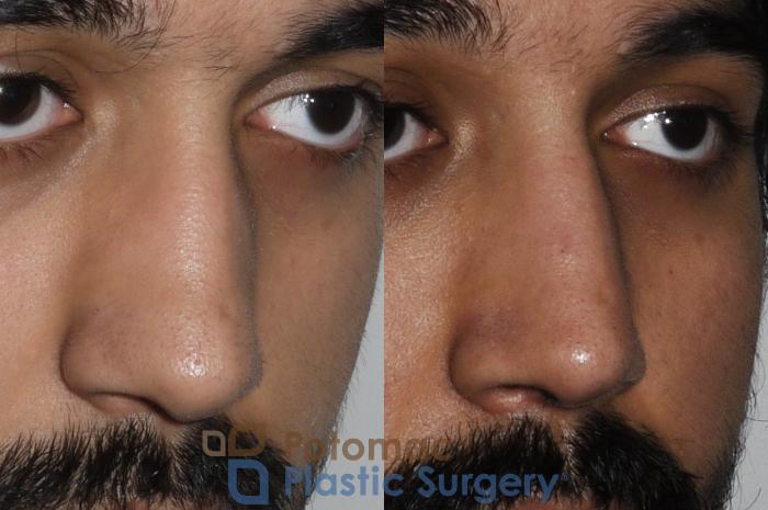 Before & After Rhinoplasty - Medical Case 192 Right Oblique View in Washington DC & Arlington , DC