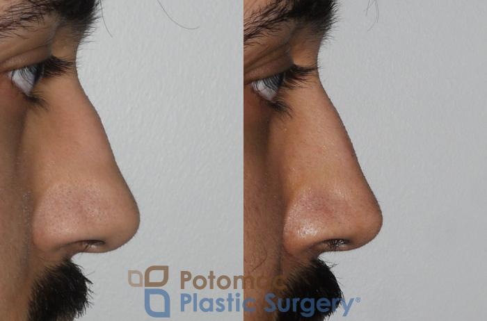 Before & After Rhinoplasty - Cosmetic Case 192 Right Side View in Washington DC & Arlington , DC