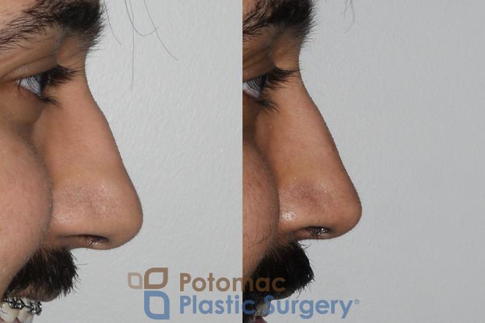 Before & After Rhinoplasty - Medical Case 192 Right Side View #2 View in Washington DC & Arlington , DC