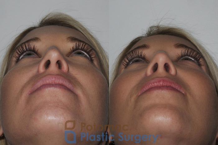 Before & After Rhinoplasty - Cosmetic Case 200 Below View in Washington DC & Arlington , DC