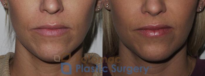 Before & After Rhinoplasty - Medical Case 200 Front Close-Up View  View in Washington DC & Arlington , DC