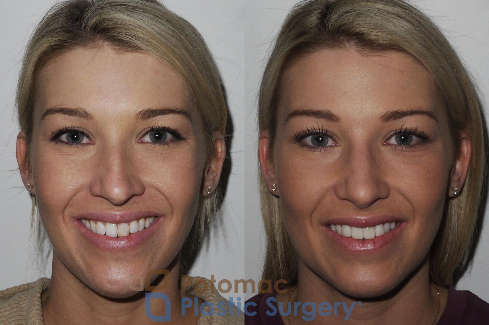 Before & After Rhinoplasty - Medical Case 200 Front View #1 View in Washington, DC