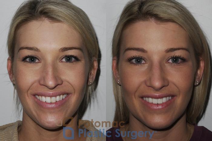 Before & After Rhinoplasty - Cosmetic Case 200 Front View #1 View in Washington DC & Arlington , DC