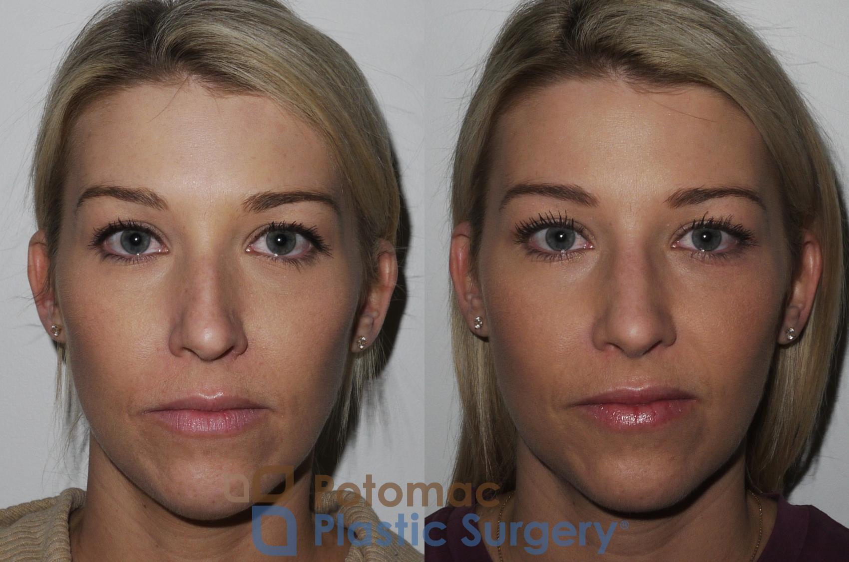 Before & After Rhinoplasty - Cosmetic Case 200 Front View #2 View in Washington DC & Arlington , DC