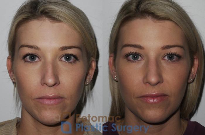Before & After Rhinoplasty - Medical Case 200 Front View #2 View in Washington DC & Arlington , DC