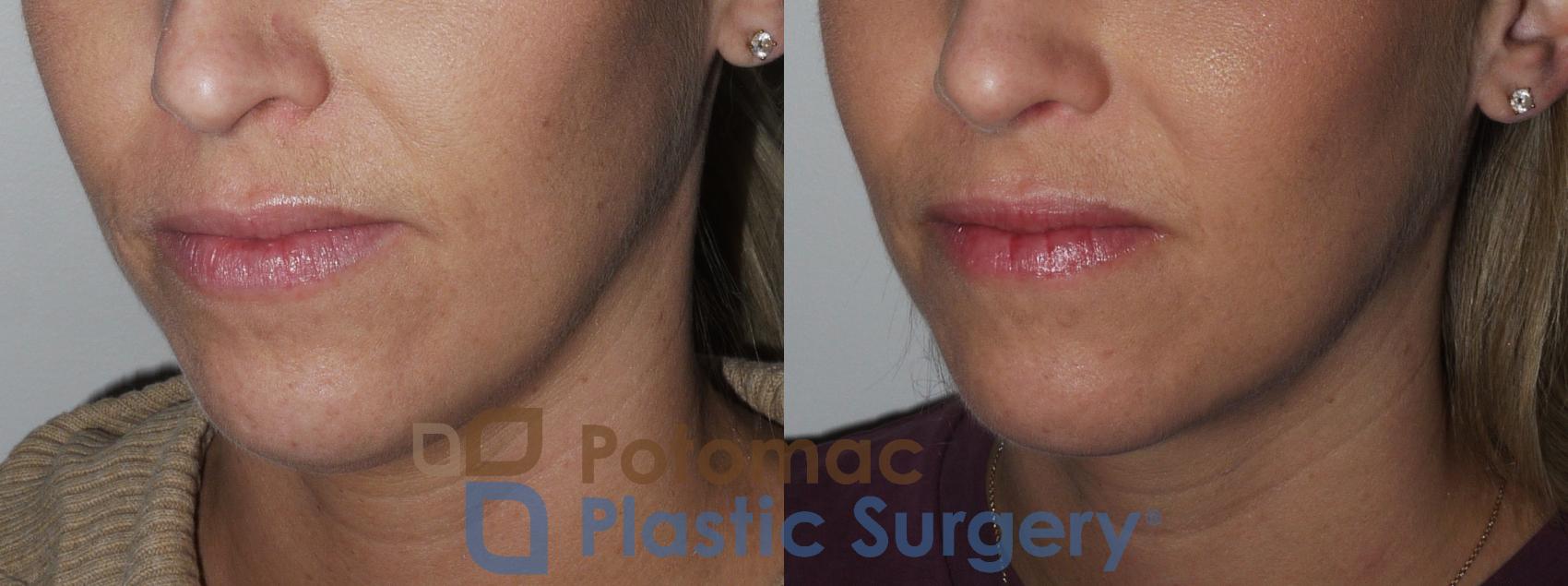Before & After Rhinoplasty - Cosmetic Case 200 Left Oblique Close-Up View in Washington DC & Arlington , DC