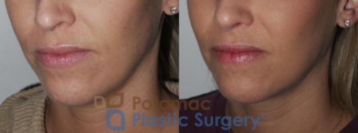 Before & After Rhinoplasty - Medical Case 200 Left Oblique Close-Up View in Washington DC & Arlington , DC