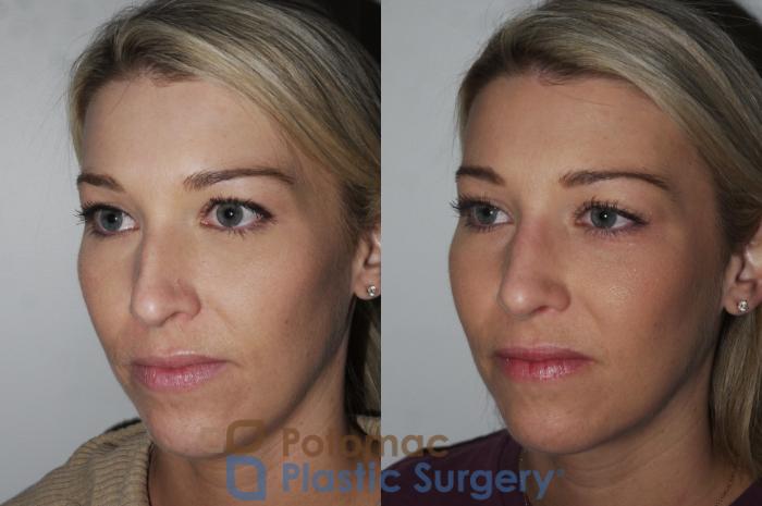 Before & After Rhinoplasty - Medical Case 200 Left Oblique View in Washington DC & Arlington , DC