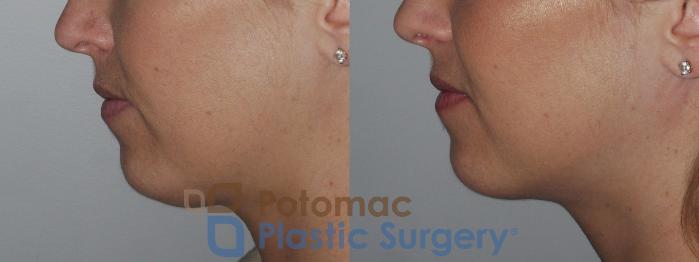 Before & After Rhinoplasty - Medical Case 200 Left Side Close-Up View in Washington DC & Arlington , DC
