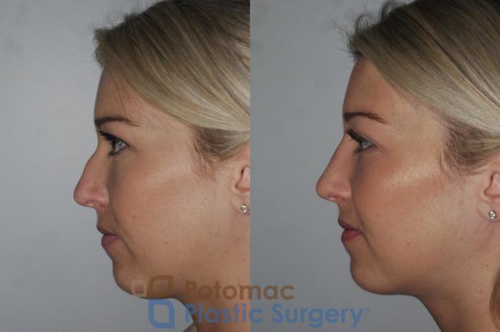 Before & After Rhinoplasty - Cosmetic Case 200 Left Side View in Washington DC & Arlington , DC