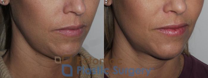 Before & After Rhinoplasty - Cosmetic Case 200 Right Oblique Close-Up View in Washington DC & Arlington , DC