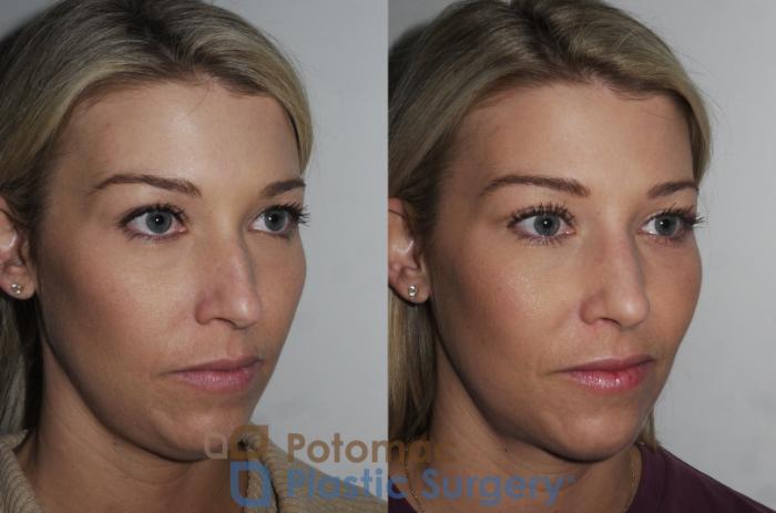 Before & After Rhinoplasty - Cosmetic Case 200 Right Oblique View in Washington DC & Arlington , DC