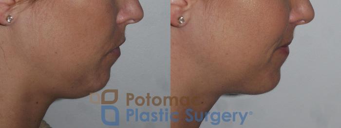Before & After Rhinoplasty - Cosmetic Case 200 Right Side Close-Up View in Washington DC & Arlington , DC