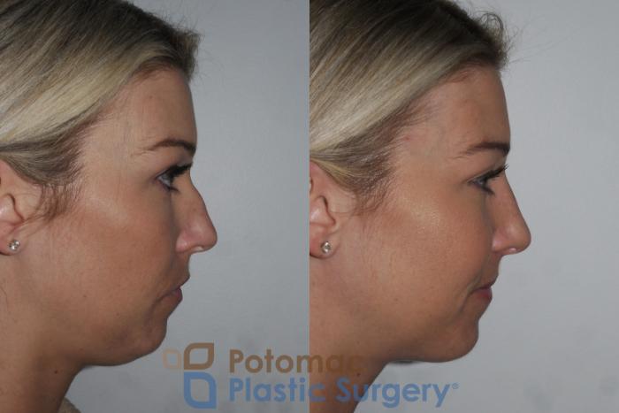 Before & After Rhinoplasty - Cosmetic Case 200 Right Side View in Washington DC & Arlington , DC