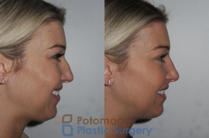 Before & After Rhinoplasty - Cosmetic Case 200 Right Side View #2 View in Washington DC & Arlington , DC