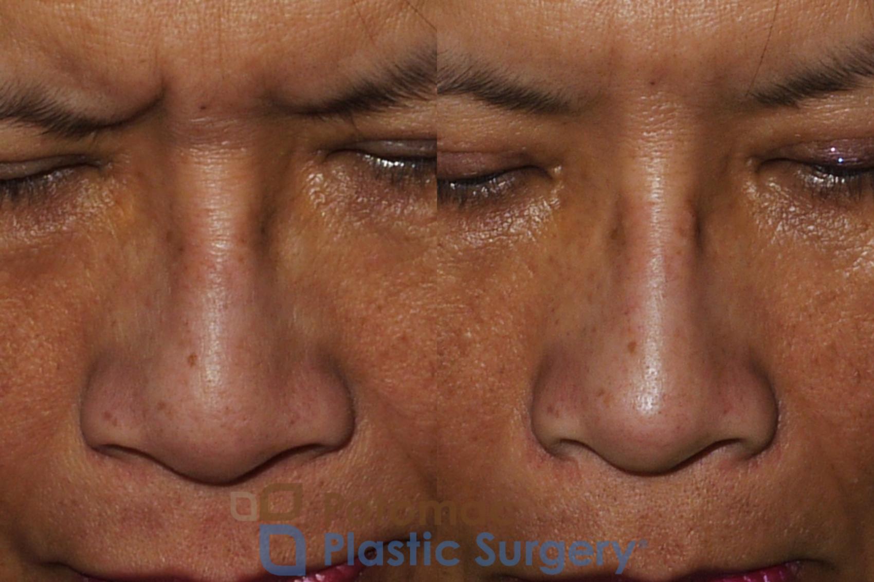 Before & After Rhinoplasty - Cosmetic Case 203 Above View in Washington, DC