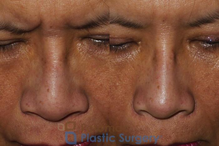 Before & After Rhinoplasty - Cosmetic Case 203 Above View in Washington DC & Arlington , DC