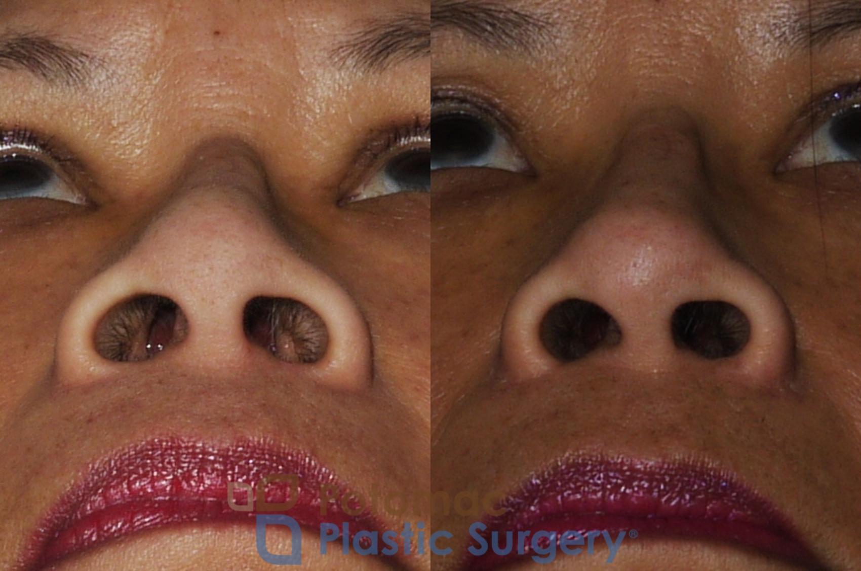 Before & After Rhinoplasty - Cosmetic Case 203 Below View in Washington, DC