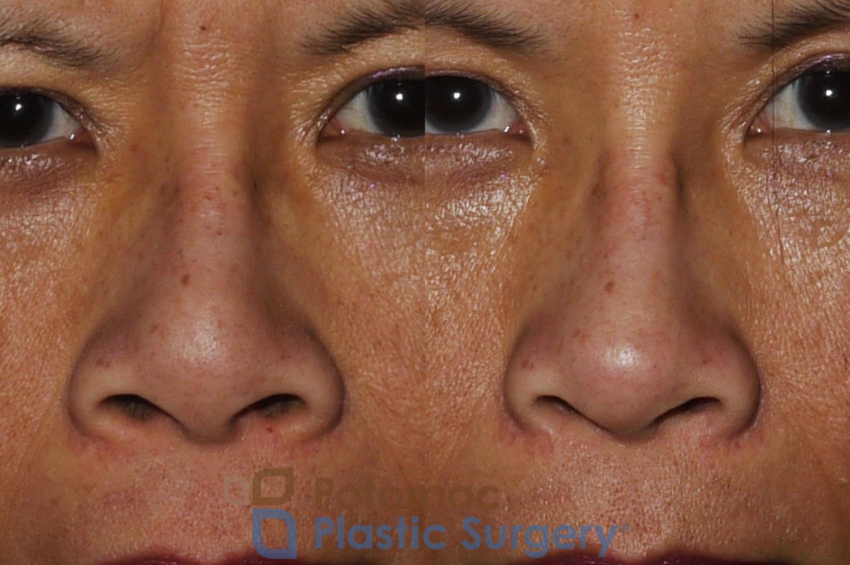 Before & After Rhinoplasty - Cosmetic Case 203 Front View in Washington DC & Arlington , DC