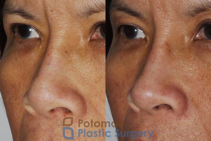 Before & After Rhinoplasty - Cosmetic Case 203 Left Oblique View in Washington DC & Arlington , DC