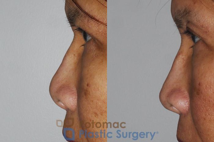 Before & After Rhinoplasty - Cosmetic Case 203 Left Side View in Washington DC & Arlington , DC