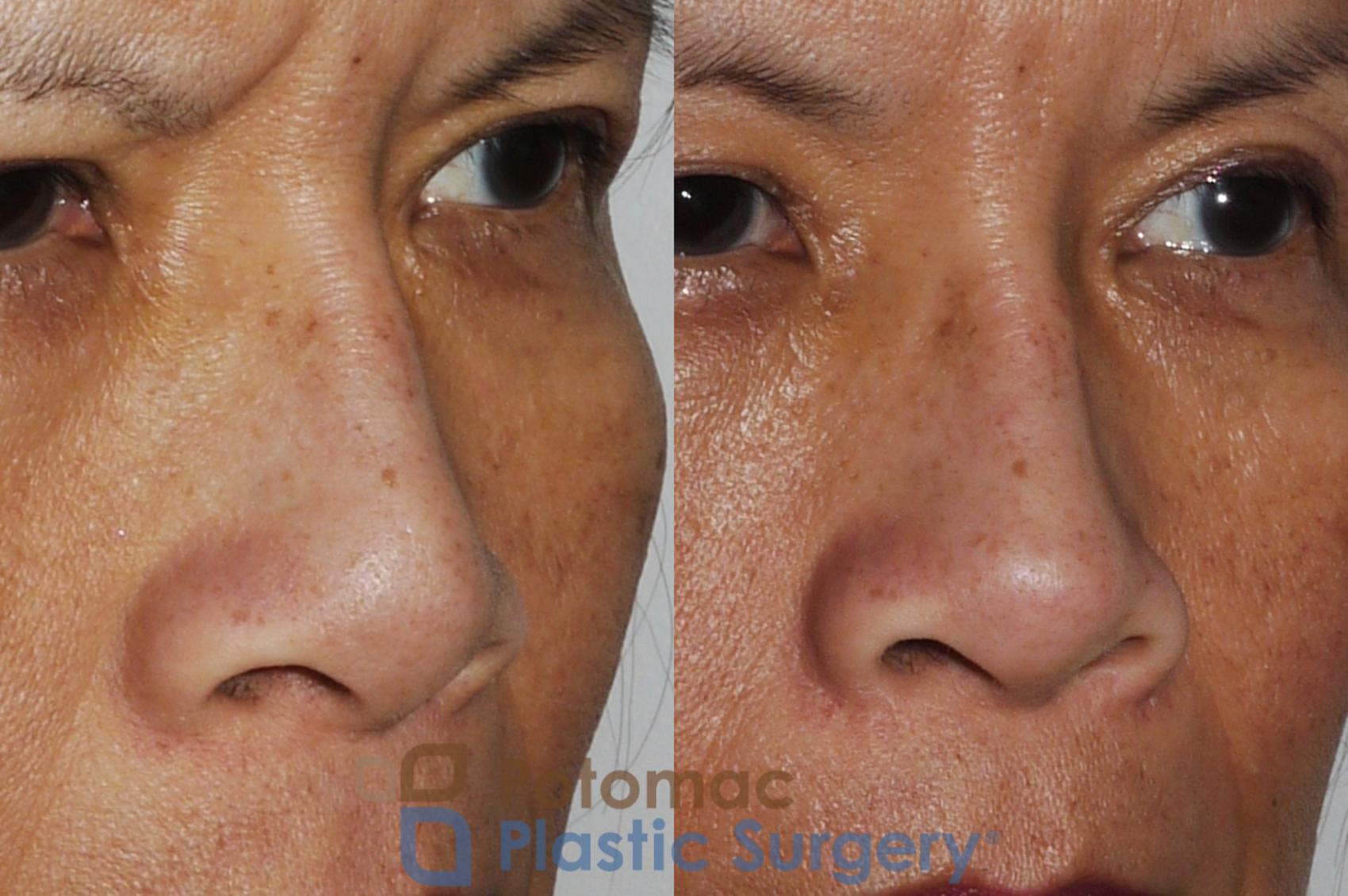 Before & After Rhinoplasty - Cosmetic Case 203 Right Oblique View in Washington, DC