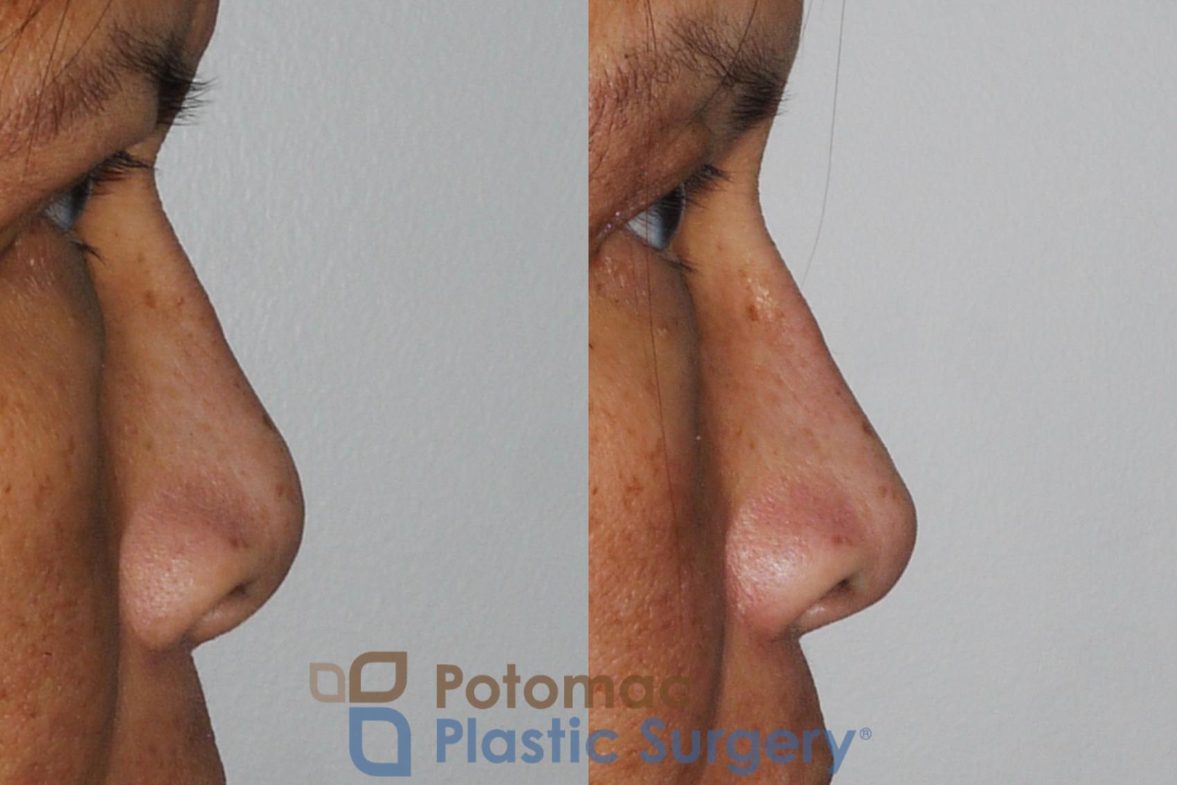 Before & After Rhinoplasty - Cosmetic Case 203 Right Side View in Washington, DC