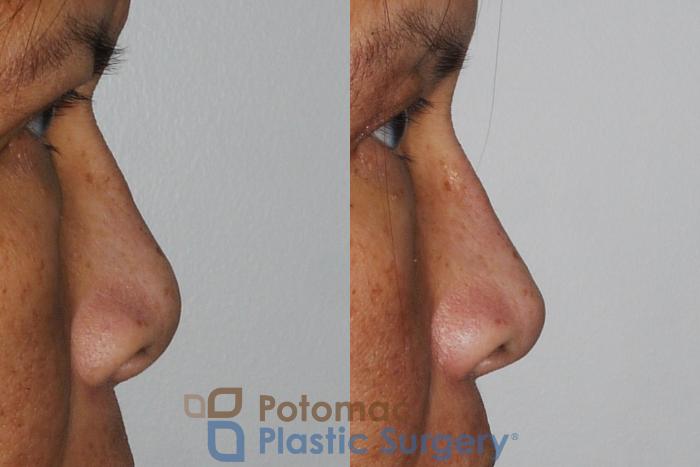 Before & After Rhinoplasty - Cosmetic Case 203 Right Side View in Washington DC & Arlington , DC