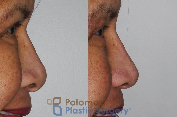 Before & After Rhinoplasty - Cosmetic Case 203 Right Side View #2 View in Washington DC & Arlington , DC