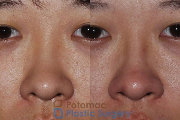 Before & After Rhinoplasty - Cosmetic Case 205 Front View in Washington DC & Arlington , DC