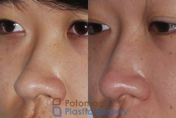 Before & After Rhinoplasty - Cosmetic Case 205 Left Oblique View in Washington DC & Arlington , DC