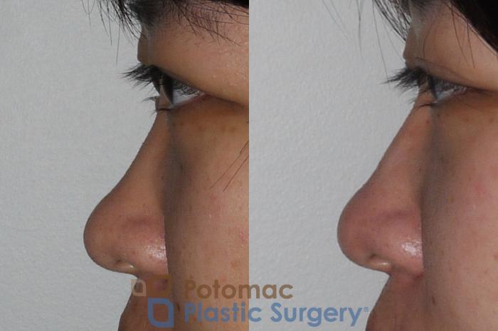 Before & After Rhinoplasty - Cosmetic Case 205 Left Side View in Washington DC & Arlington , DC