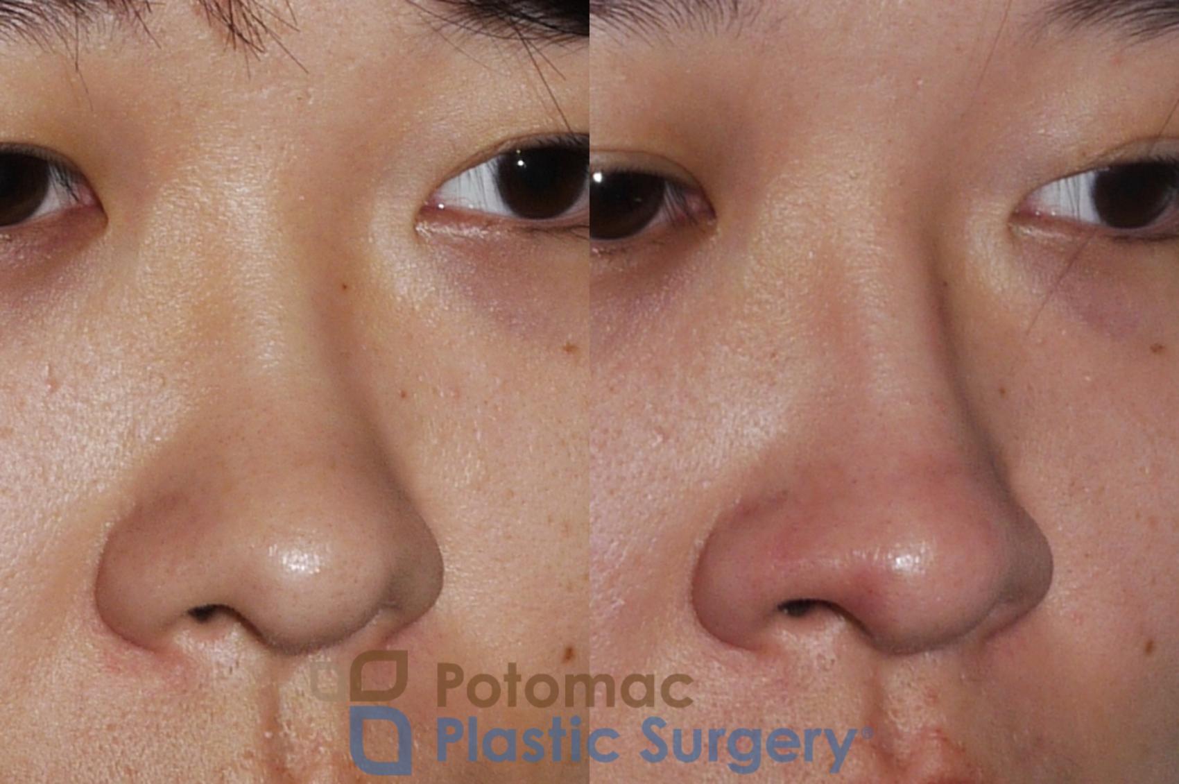 Before & After Rhinoplasty - Cosmetic Case 205 Right Oblique View in Washington DC & Arlington , DC