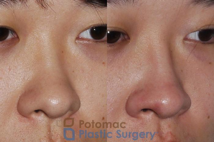 Before & After Rhinoplasty - Cosmetic Case 205 Right Oblique View in Washington DC & Arlington , DC