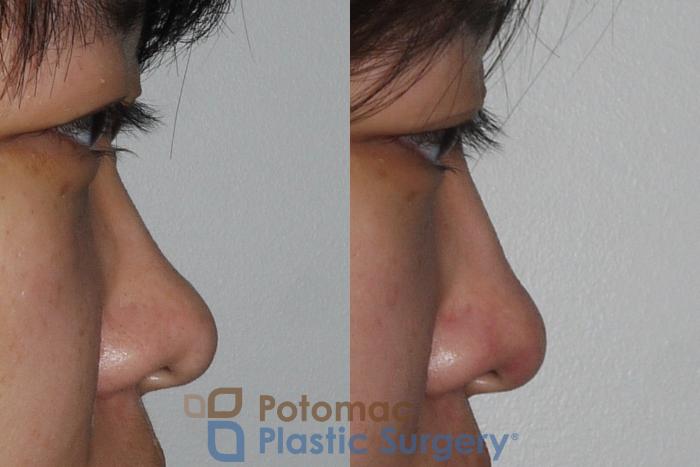Before & After Rhinoplasty - Cosmetic Case 205 Right Side View in Washington DC & Arlington , DC